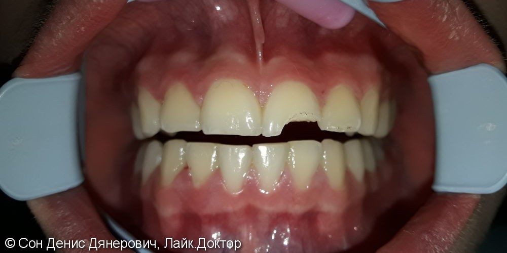 Эстетическая реставрация фронтального зуба светоотверждаемым материалом Filtek (США) - фото №1