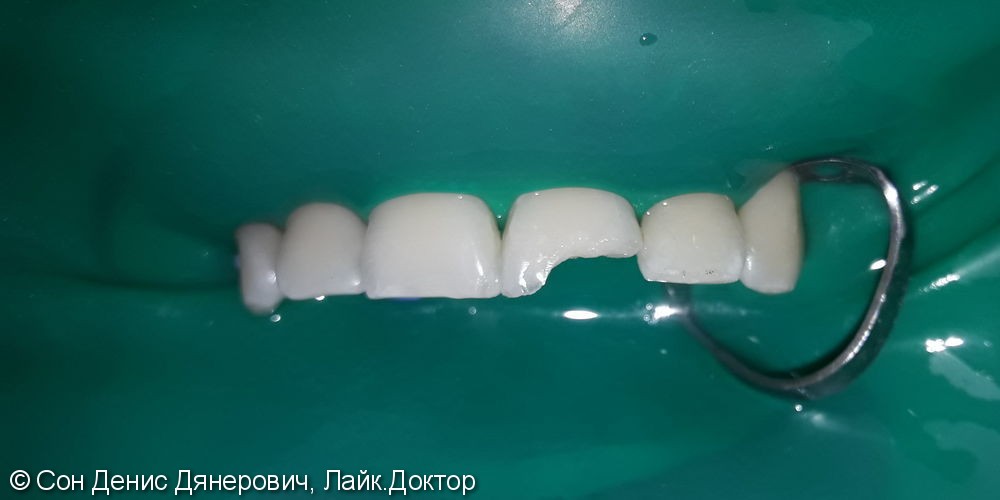 Эстетическая реставрация фронтального зуба светоотверждаемым материалом Filtek (США) - фото №2