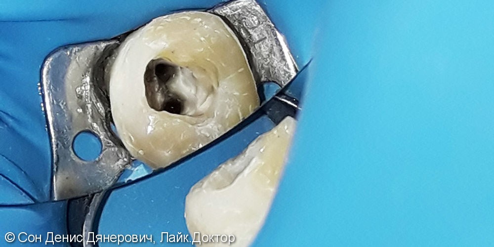 Лечение и установка временной пломбы на зуб №48 - фото №1
