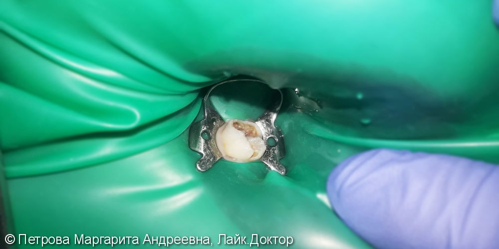 Лечение и реставрация двух зубов фотополимером Ceram-X - фото №1