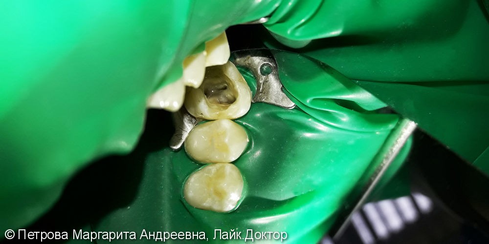 Лечение и реставрация зуба №26 фотополимером Esthet-X - фото №1