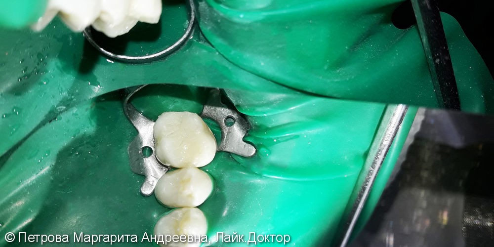 Лечение и реставрация зуба №26 фотополимером Esthet-X - фото №3
