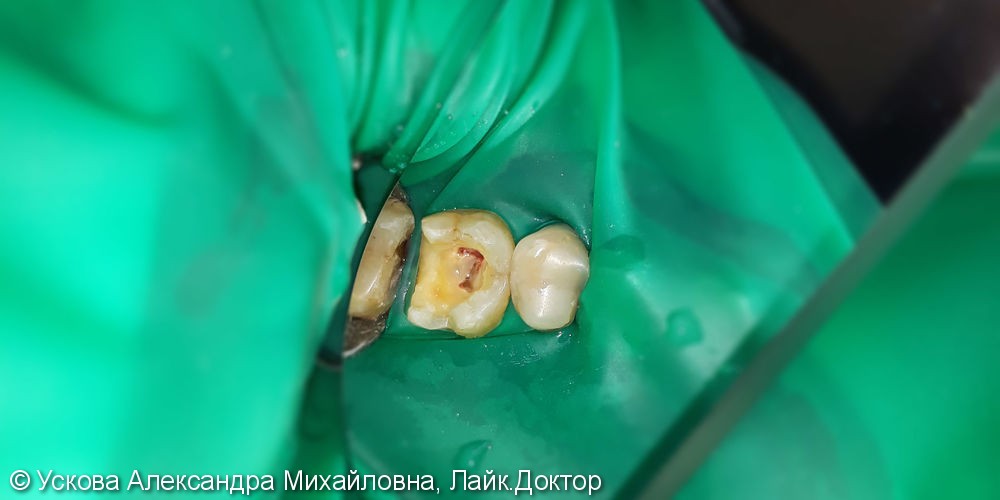 Лечение и реставрация зуба №26 фотополимером российского производства - фото №1