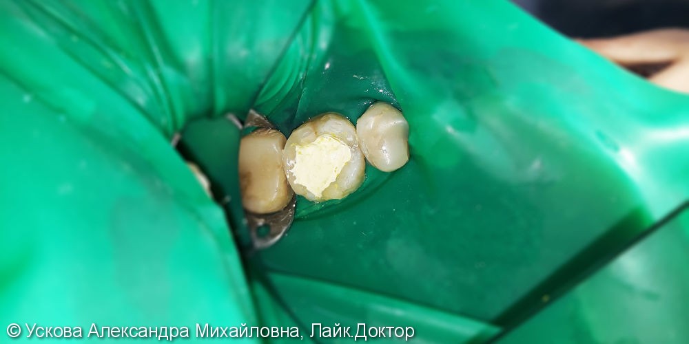 Лечение и реставрация зуба №26 фотополимером российского производства - фото №2