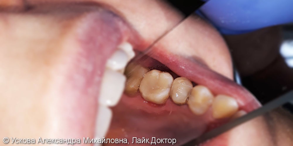 Лечение и реставрация зуба №26 фотополимером российского производства - фото №3