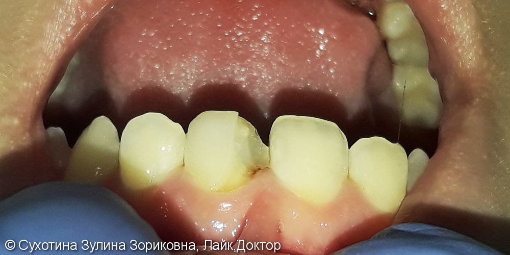 Эстетическая реставрация зуба №21 отечественным фотополимером - фото №1