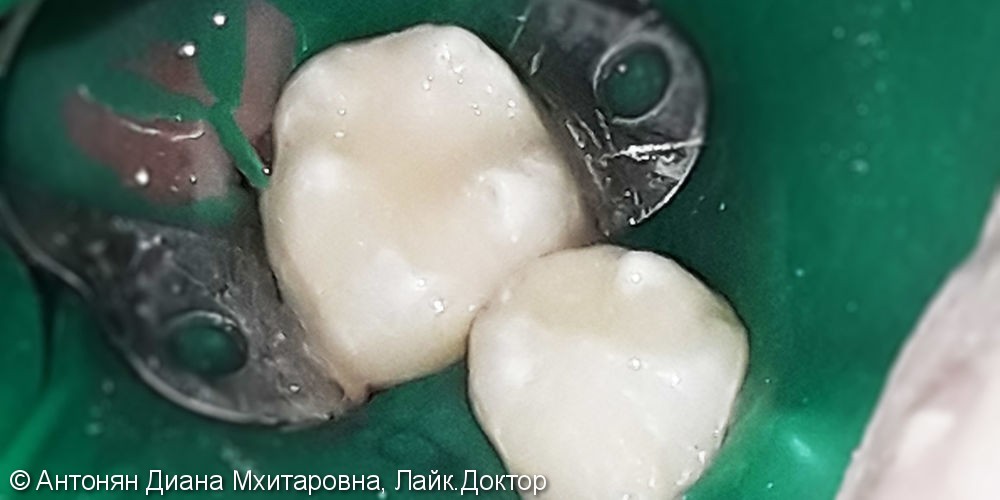 Лечение фиссурного кариеса зубов №45/№46 с использованием медикаментозного сна - фото №3