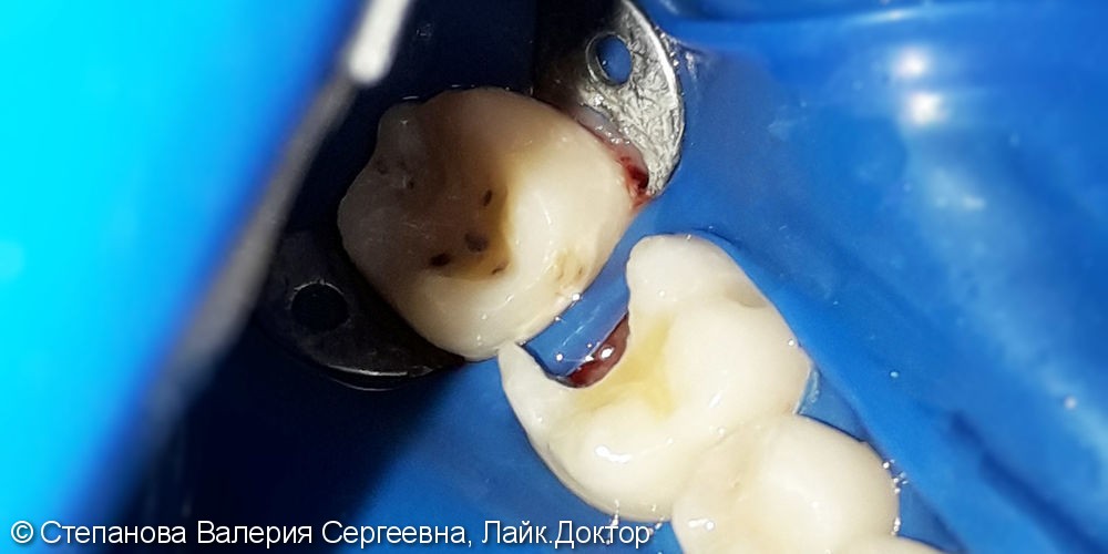 Лечение и реставрация зуба №36 отечественным фотополимером - фото №2