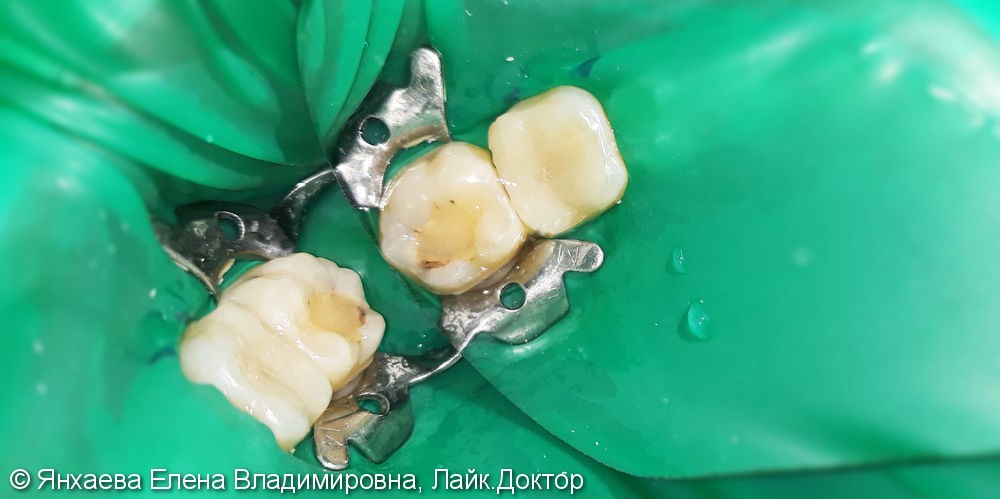Лечение и реставрация зуба №47 фотополимером российского производства - фото №1