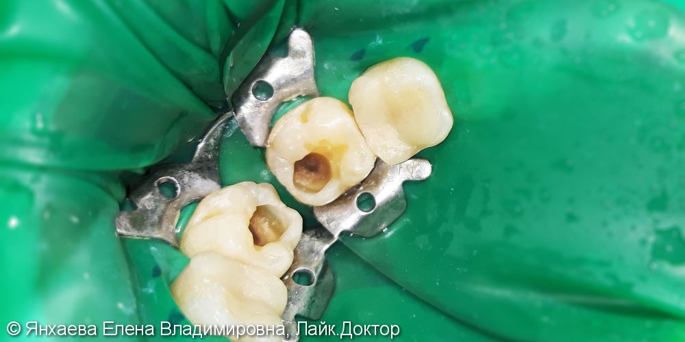 Лечение и реставрация зуба №47 фотополимером российского производства - фото №2