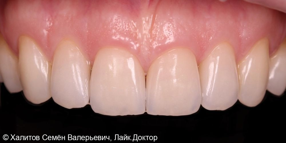 Клинический случай установки 6 ультратонких керамических виниров после ортодонтического лечения - после