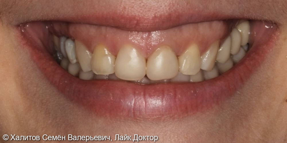 Эстетическая реабилитация улыбки и отбеливание зубов - после
