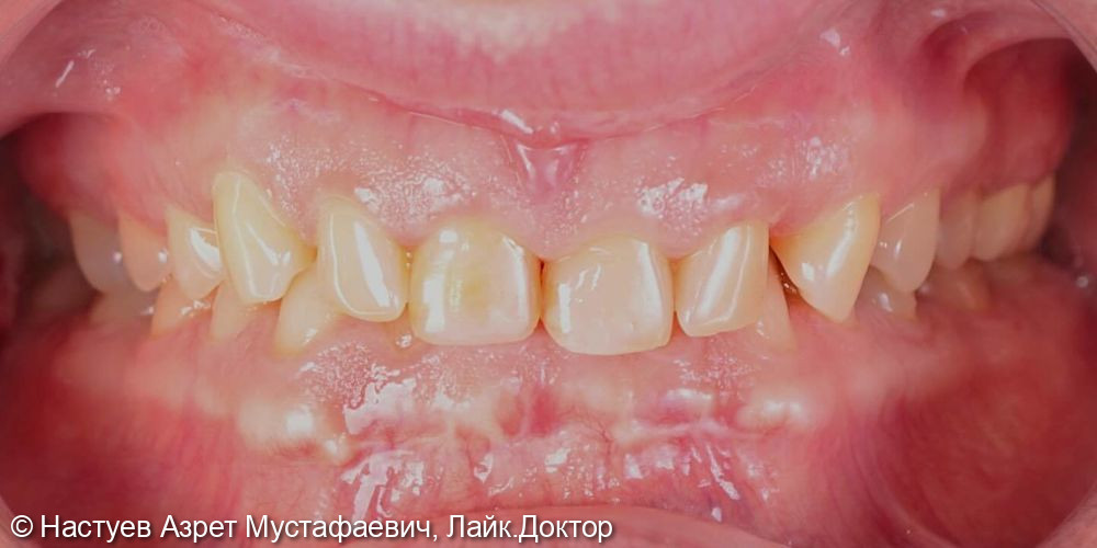 Установка циркониевых коронок на все зубы - фото №1