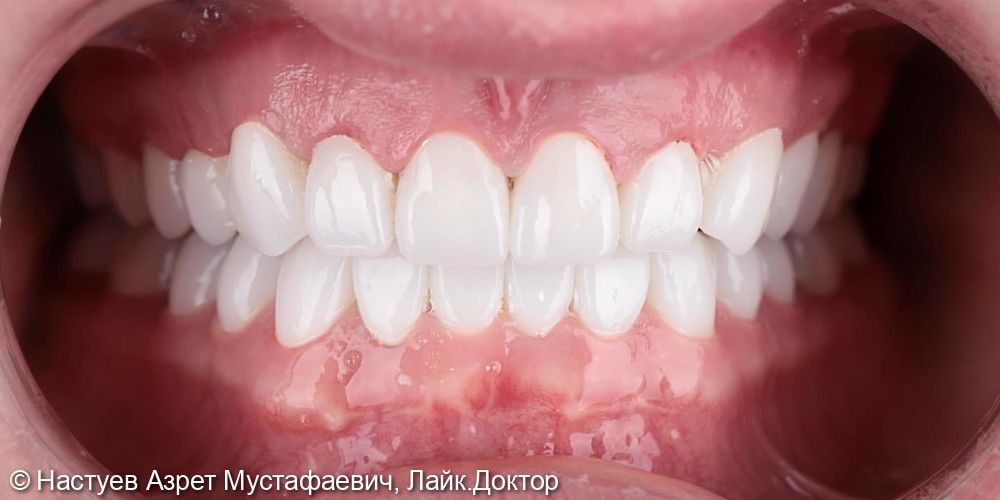 Установка циркониевых коронок на все зубы - фото №2
