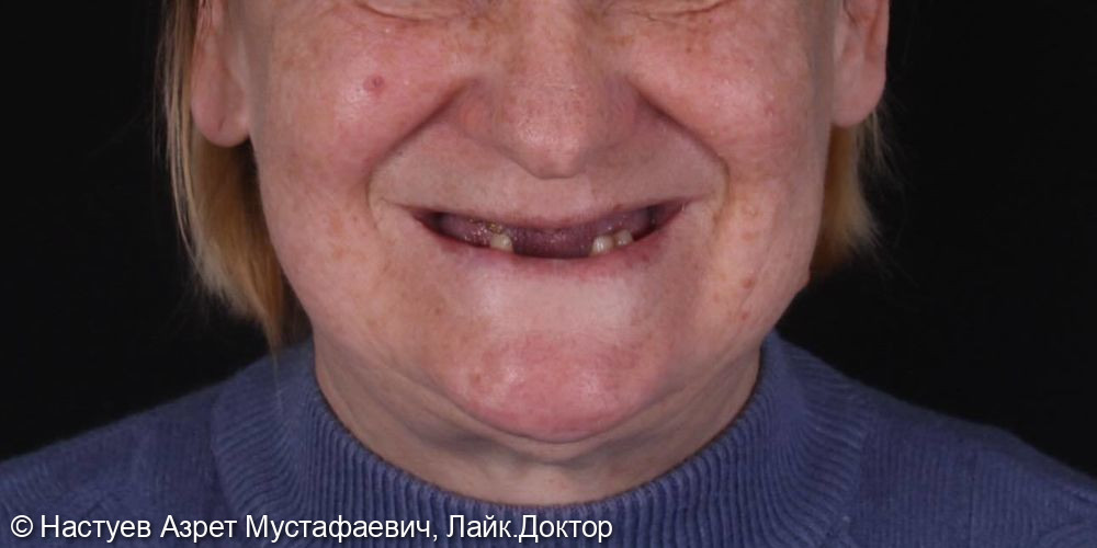 Преображение улыбки всего за 3 дня - фото №1