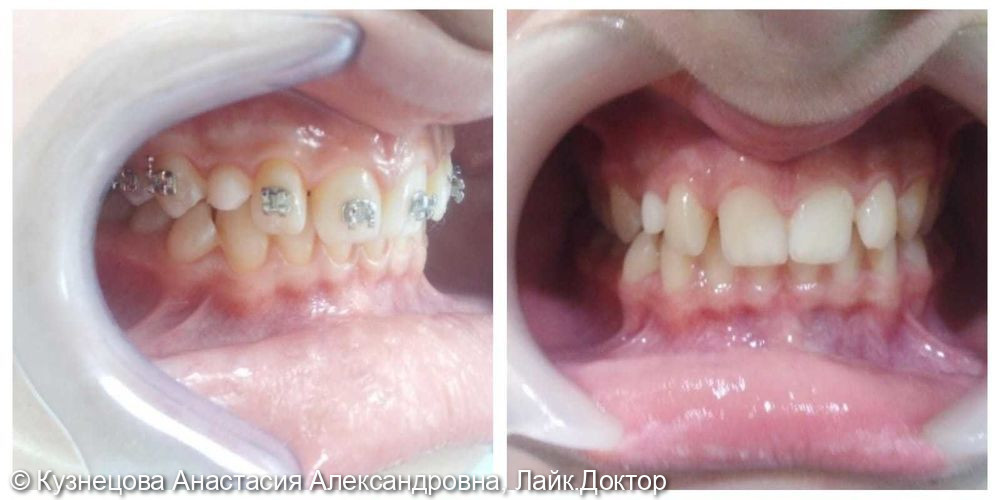 Коррекция прикуса, установка ретенированного клыка в зубной ряд - фото №1