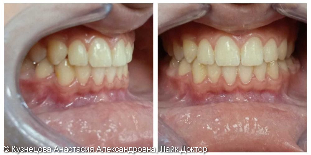 Коррекция прикуса, установка ретенированного клыка в зубной ряд - фото №2