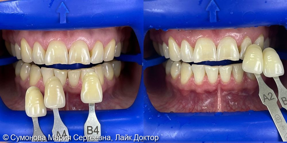 Эстетическая реставрация и отбеливание зубов - фото №1