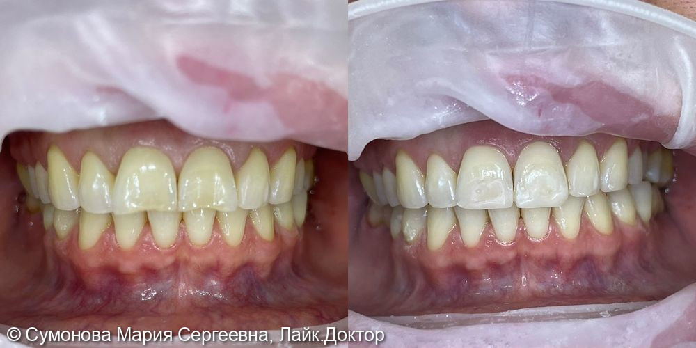 Эстетическая реставрация и отбеливание зубов - фото №2