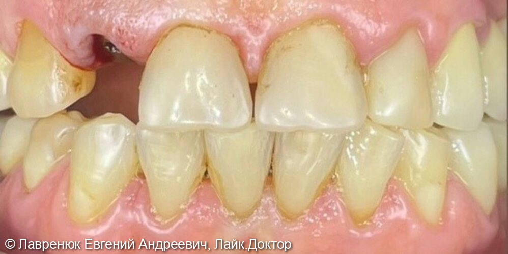 Протезирование переднего зуба верхней челюсти на импланте Straumann BLX - фото №1