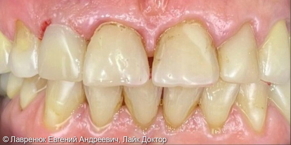 Протезирование переднего зуба верхней челюсти на импланте Straumann BLX - фото №2