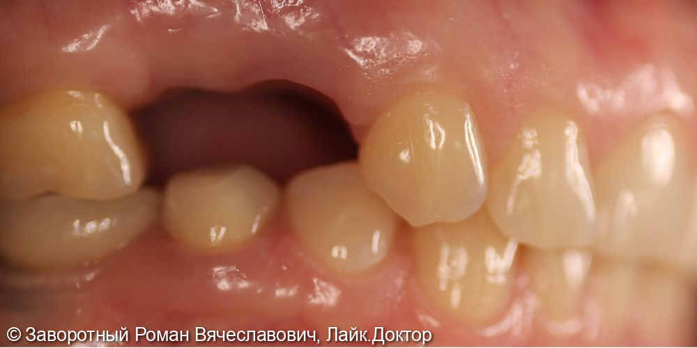 Восстановление отсутствующих зубов при помощи дентальных имплантатов и керамических коронок - фото №1