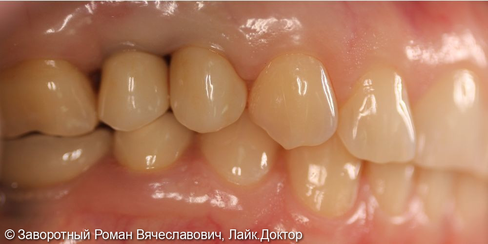 Восстановление отсутствующих зубов при помощи дентальных имплантатов и керамических коронок - фото №2