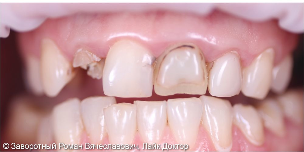 Керамические коронки E-max с индивидуальной эстетикой на фронтальную группу зубов верхней челюсти - фото №1