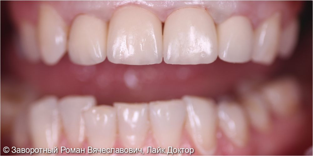 Керамические коронки E-max с индивидуальной эстетикой на фронтальную группу зубов верхней челюсти - фото №2