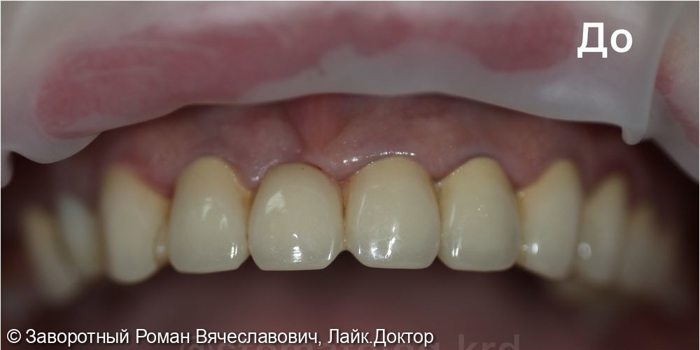 Эстетическая реабилитация зубов верхней челюсти при помощи керамических реставраций (E-max) - фото №1