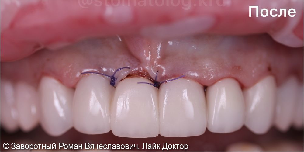 Эстетическая реабилитация зубов верхней челюсти при помощи керамических реставраций (E-max) - фото №2