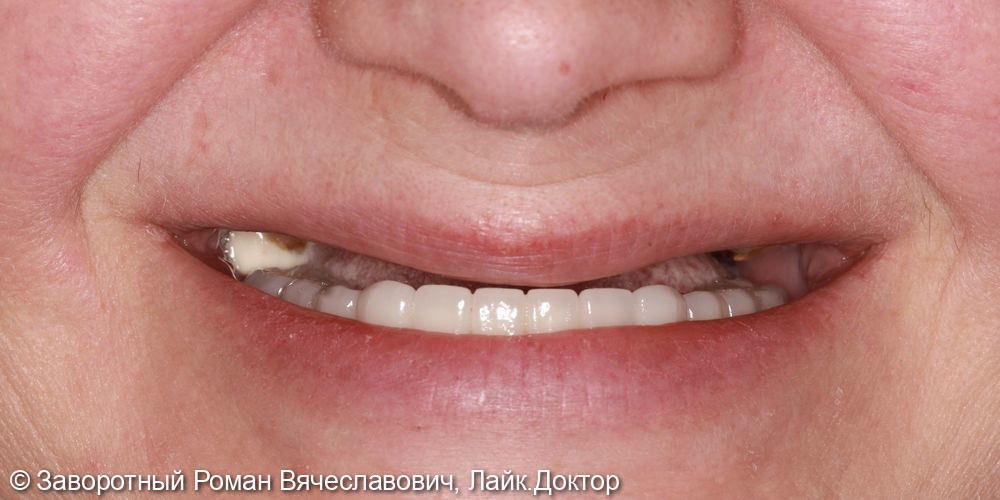 Восстановление зубного ряда на верхней челюсти при помощи дентальных имплантатов по системе ALL-on-6 (всё на шести имплантах) - фото №1