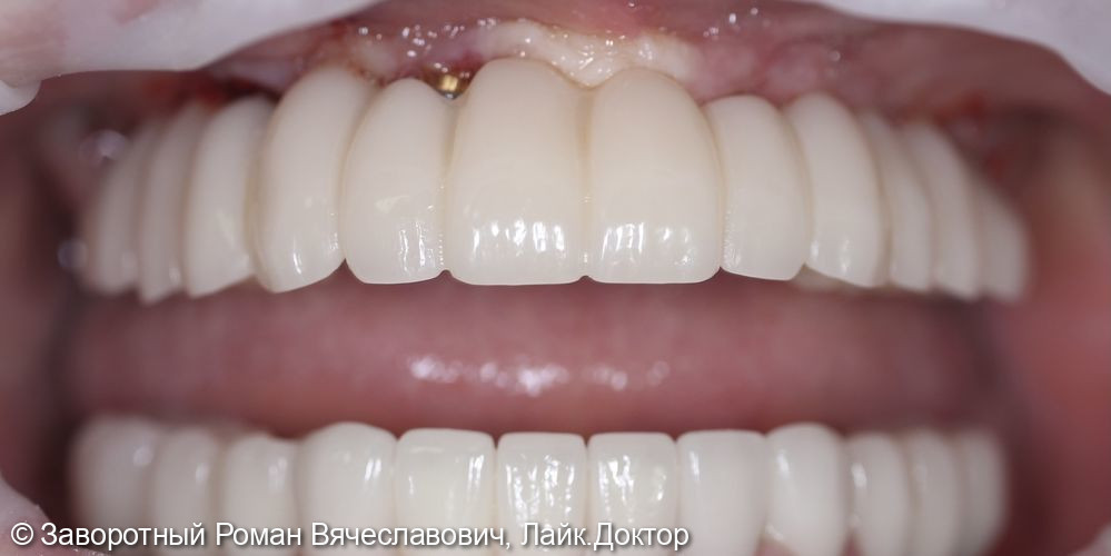 Восстановление зубного ряда на верхней челюсти при помощи дентальных имплантатов по системе ALL-on-6 (всё на шести имплантах) - фото №4