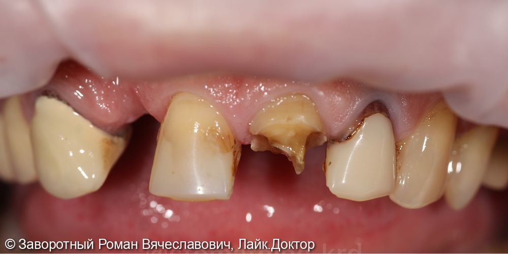 Комплексное восстановление фронтальных зубов верхней челюсти - фото №1