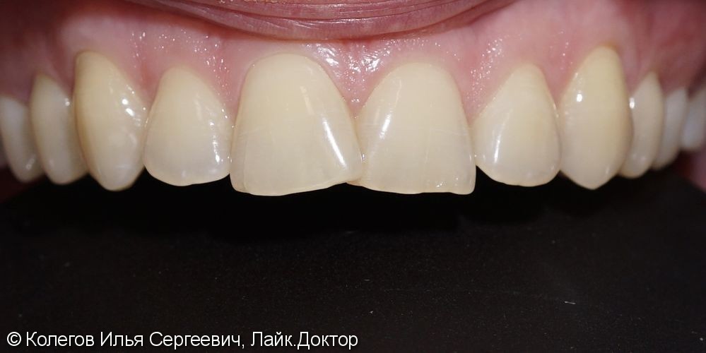 Исправлена легкая кривизна зубов керамическими винирами E.Max - фото №2