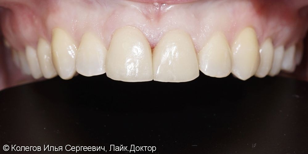 Исправлена легкая кривизна зубов керамическими винирами E.Max - фото №3