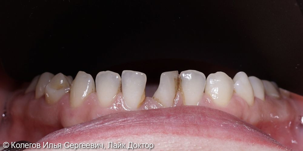 Установка керамических виниров на нижние зубы - фото №1