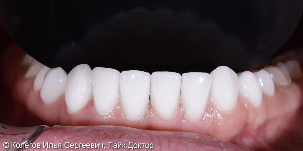 Установка керамических виниров на нижние зубы - фото №2