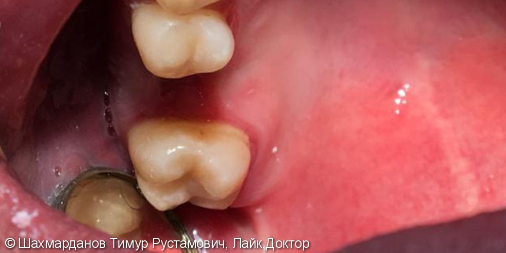 Лечение фиссурного кариеса 1.7 зуба - фото №4